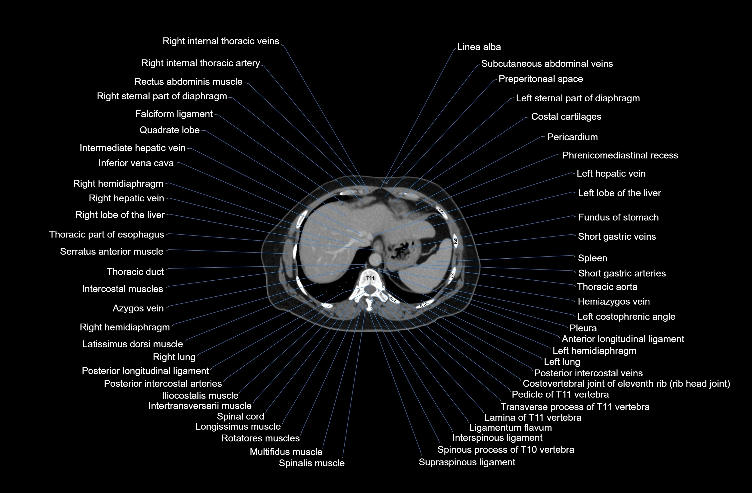CT Abdomen axial cross sectional anatomy labelled radiology image-00011.webp